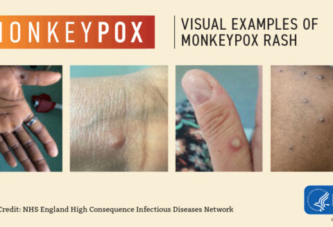 Monkeypox Questions?
